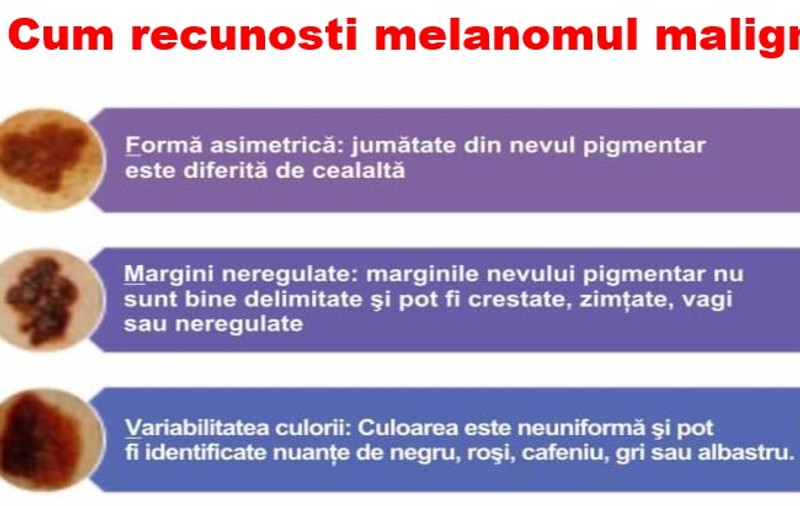 5 semne prin care recunoști cel mai temut cancer de piele