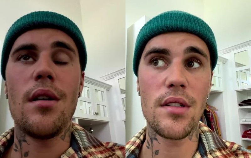 Justin Bieber a anunțat că are paralizie facială din cauza sindromului Ramsay Hunt: „Este destul de grav”