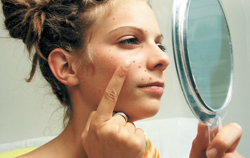 Tratează acneea la dermatolog!