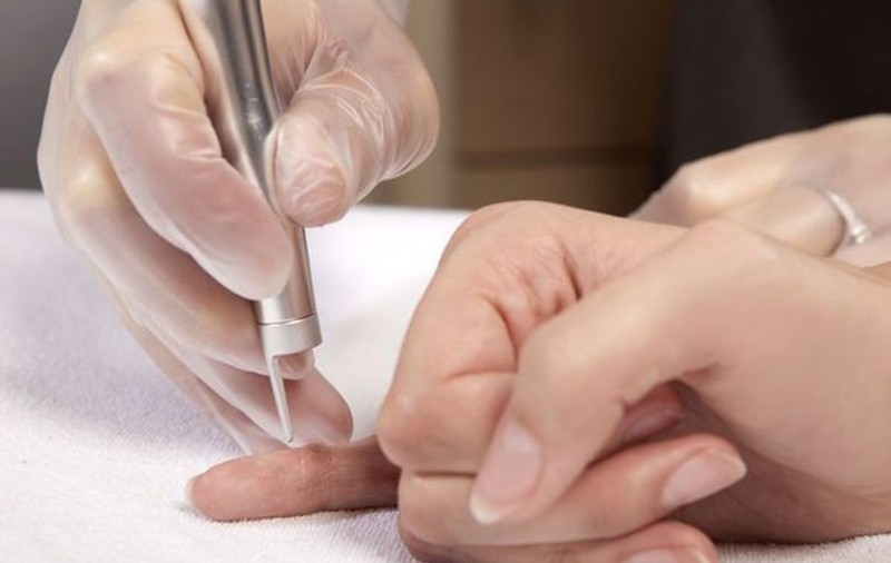 ATENȚIE! Negii se tratează NUMAI la dermatolog