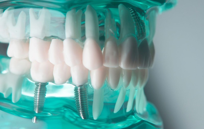 Implant Studio - Zâmbete perfecte fără durere