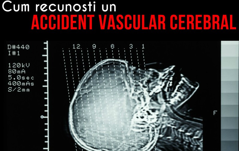 Accidentul vascular cerebral