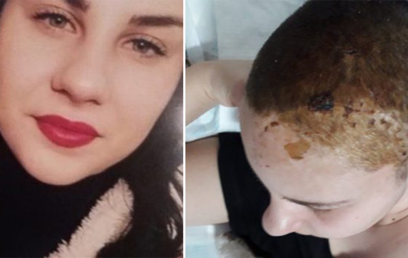 EXCLUSIV/ Adolescenta căzută acum o lună dintr-un autobuz în Ploiești nu a fost încă audiată de polițiști. Imagini cu fata la scurt timp după operație/FOTO