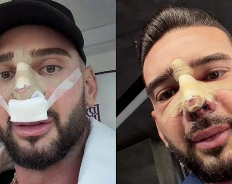 Cum se simte Dorian Popa după operația suferită la nas. „Dacă sunteți în context, nu vă speriați”