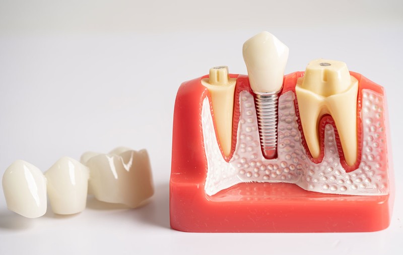 Avantajele implantului dentar: care sunt beneficiile?