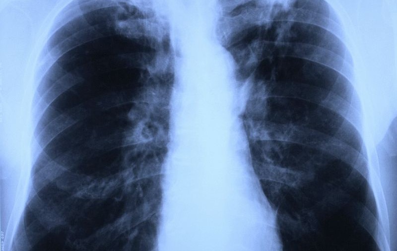 România numără cele mai multe cazuri de tuberculoză din UE