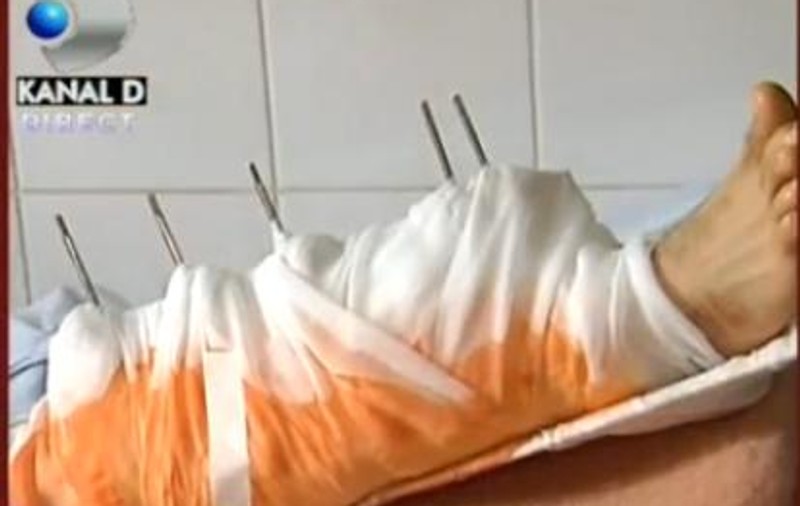 ŞOCANT! Bărbatul căruia jandarmii i-au rupt piciorul nu va mai merge niciodată normal | VIDEO  