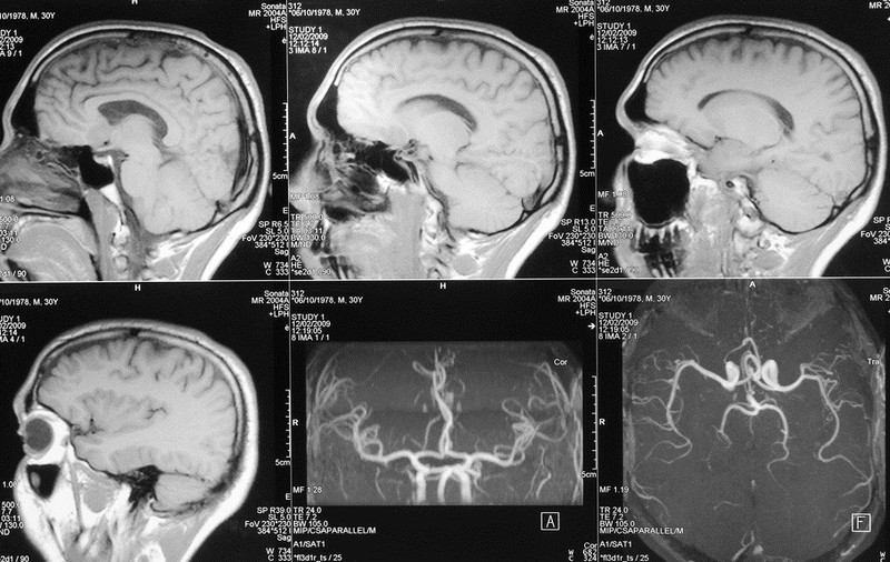 Cancerul cerebral: Care sunt simptomele unei tumori pe creier