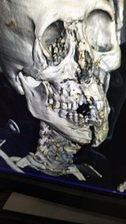 Radiografia feței lui Yasser Al-Shahran | Sursa: captură Twitter via GSP