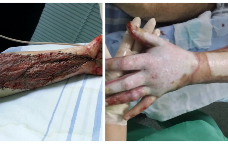 SECRETELE "COLECTIV": În timp ce marii arși au fost lăsați acasă, în primul avion a fost îmbarcat un ziarist fără răni grave, afectat doar pe mâini, cu recomandarea ”continuarea tratamentului și kinetoterapie”!
