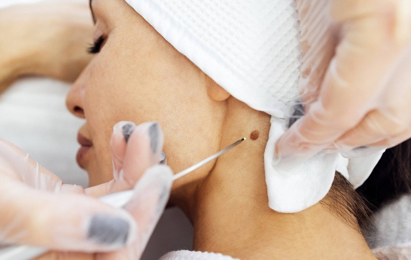 De ce să-ți scoți alunițele iarna. Dr. Raluca Radu, medic dermatolog, explică riscurile și semnele de alarmă