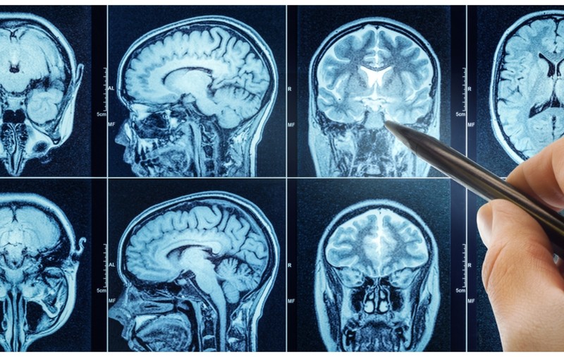 7 afecțiuni ce pot fi detectate cu ajutorul unui RMN cerebral