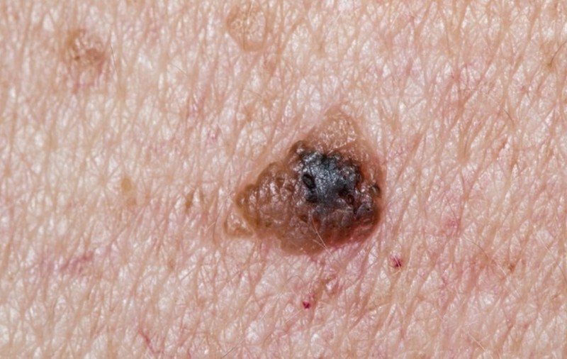 Cum recunoști melanomul