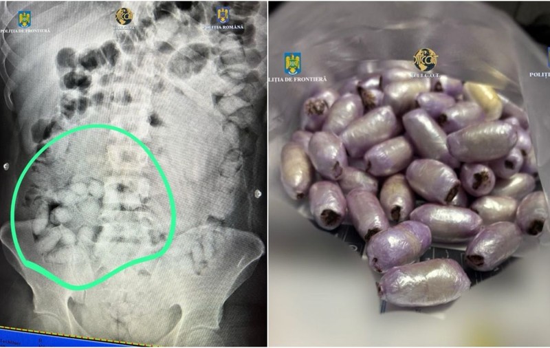 Un brazilian care înghițise capsule cu cocaină și avea altele lipite pe picioare, prins pe Aeroportul Otopeni din București - Foto