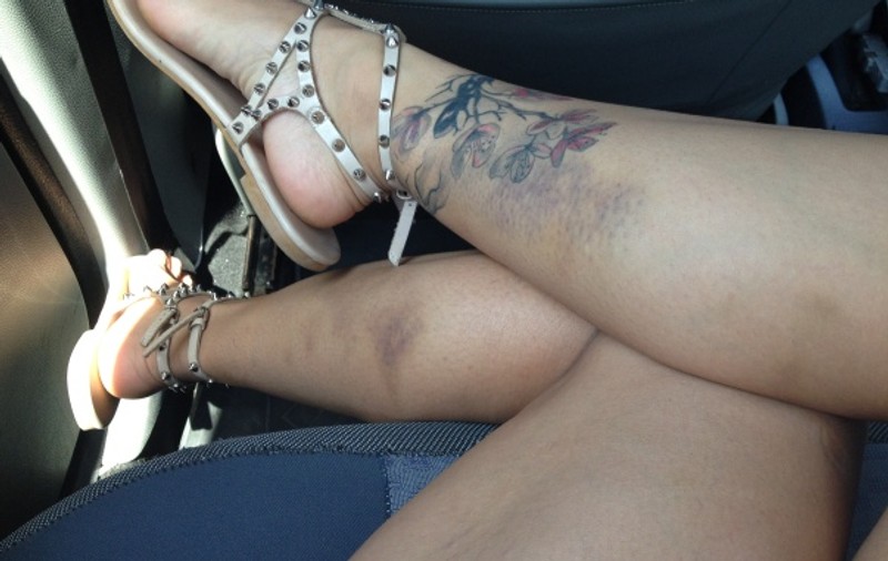 Află de ce e Andreea Popescu plină de vânătăi 