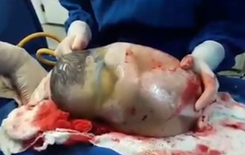 Momentul incredibil în care un bebeluş se naşte cu sacul amniotic intact | VIDEO