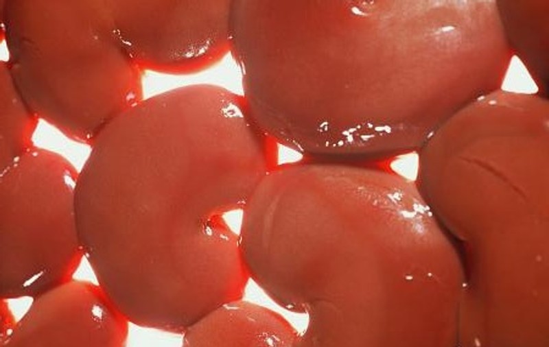 Două surori şi mama i-au donat câte un rinichi