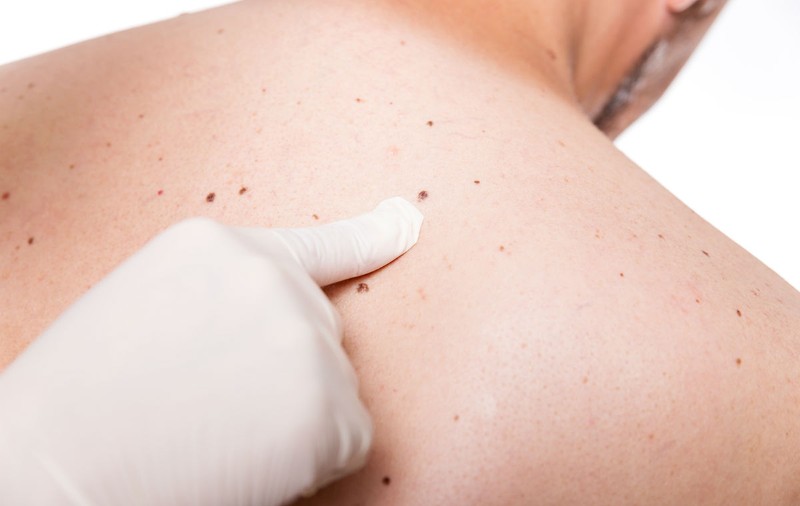 S.O.S. cancerul de piele! Chiar şi când stai la umbră aluniţele sunt în pericol