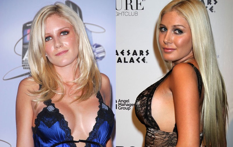 Heidi Montag zici că-i sculptată, dar este plină de cicatrici
