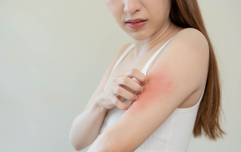 Remedii eficiente pentru alergia la soare - ce este alergia la soare