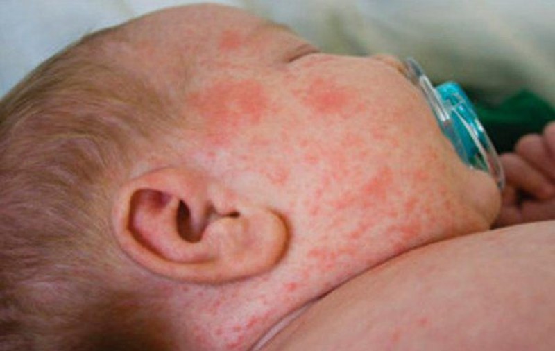 Epidemia de rujeolă, de neoprit. Alte 208 cazuri noi în ultima săptămână