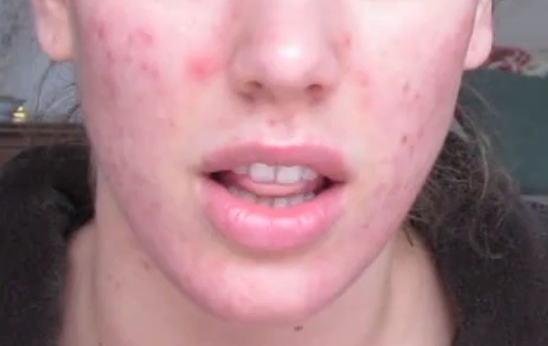ACNEEA, COMBĂTUTĂ DE O TÂNĂRĂ cu un INGREDIENT pe care îl are ORICINE ÎN BUCĂTĂRIE! EFECTUL ESTE FABULOS, de la o zi la alta! VIDEO