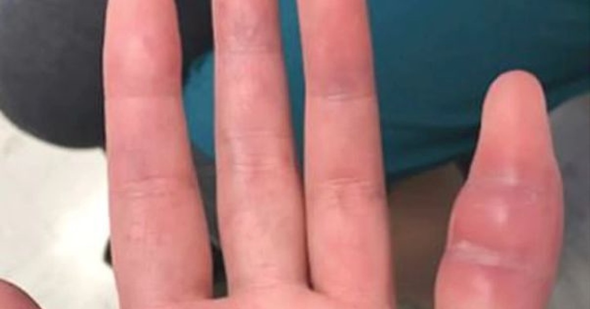 Unei femei i s-a umflat un deget de la o mână. Degetul umflat al femeii, de la mâna stângă