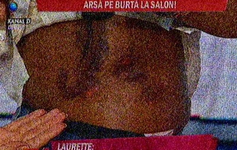 Vizita la salonul de înfrumusețare a costat-o scump! Laurette are carne vie pe burtă! FOTO