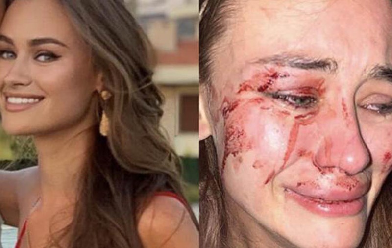 Un celebru model, bătut până la sânge într-un club din Turcia: “Am crezut că mi-am pierdut ochiul și mi s-a terminat cariera”