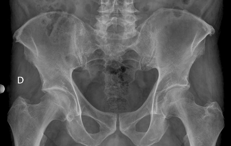 Un BĂTRÂNEL de 94 de ani s-a dus la spital cu DURERI CRUNTE de burtă. Medicii, uimiţi de ce avea în abdomen. Era acolo de 70 de ani