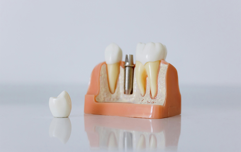 Știi că există modalitatea de implant dentar all on 6 în Suceava? Află amănunte în acest articol