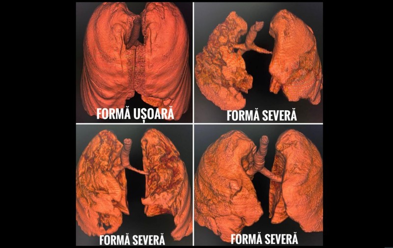 Cum modifică infecția cu coronavirus plămânii pacienților nevaccinați. Patru tomografii, publicate de CNCAV