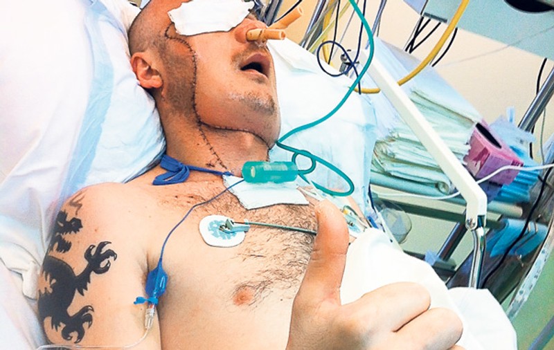 Premieră medicală mondială în Polonia! I-au schimbat faţa în 27 de ore