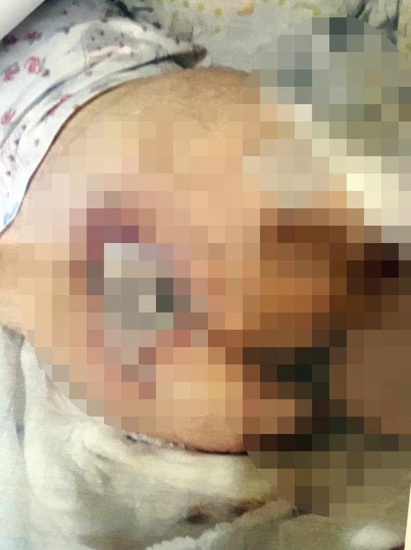 Escara de pe spate, deasupra posteriorului. Redacția Libertatea a ales să blureze părți din imagini, întrucât consideră că pot aduce atingere demnității persoanei prezentate, fără a aduce un beneficiu interesului public.