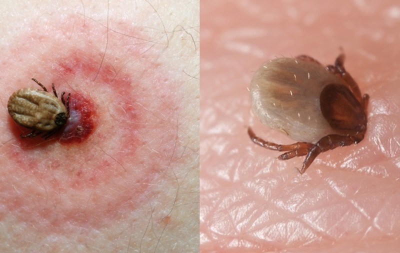 Boala Lyme: riscul de infectare este mic!