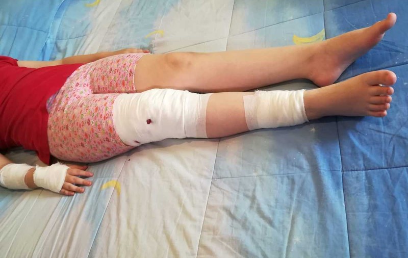 Fetiță de 10 ani, sfâșiată de un câine în Mediaș. Maidanezul a mușcat-o și de nas / FOTO