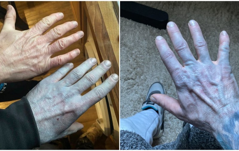 A ajuns la Urgențe cu pielea albastră și a fost pus pe oxigen. Ce au descoperit medicii: „Le-am oferit un motiv de râs”