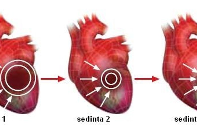 Revascularizarea inimii cu ajutorul undelor acustice - CardioFort
