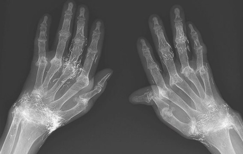 O femeie are încheieturile de la mâini cu firicele de aur. Cazul care i-a uluit pe doctori