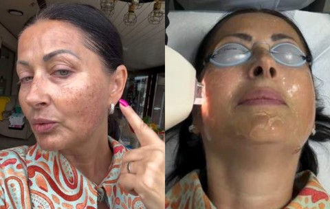 Gabriela Cristea, tratament facial cu laser