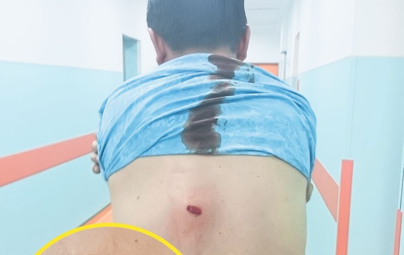 Un glonţ buclucaş i-a găurit spatele de la 2 kilometri