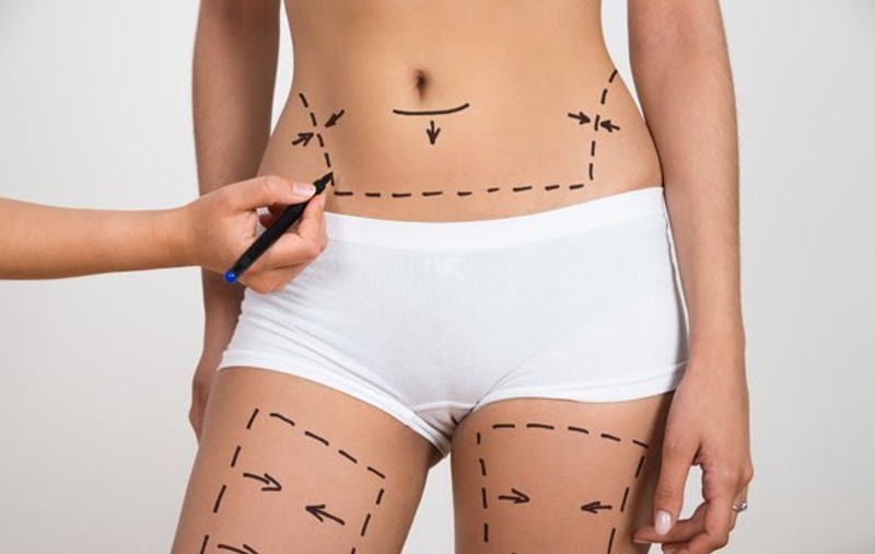 2.000 de euro – un lifting corporal total. Merită?