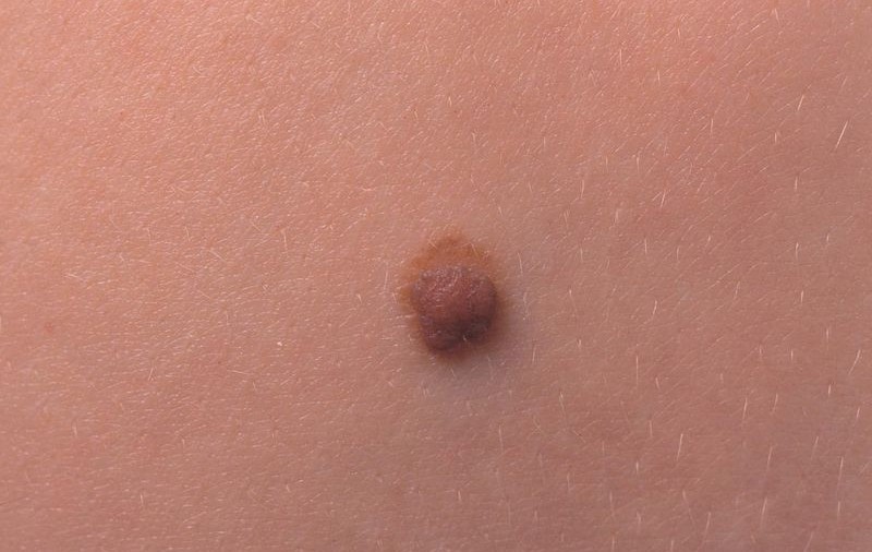 Cancerul de piele poate fi învins