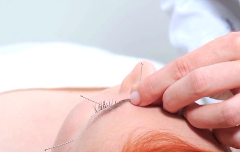 Iată cum te vindecă acupunctura!