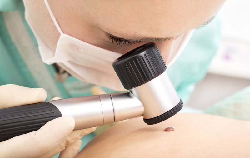 Rapidă şi exactă: metoda care previne cancerul de piele