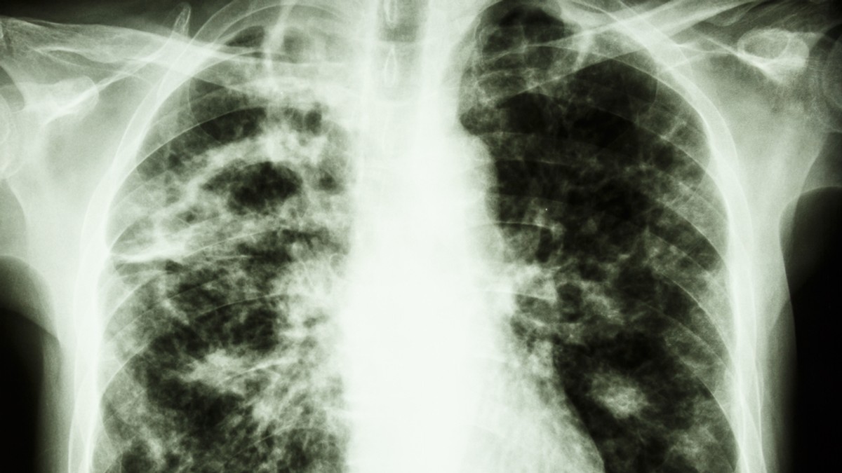 cele mai multe cazuri noi de tuberculoză înregistrate