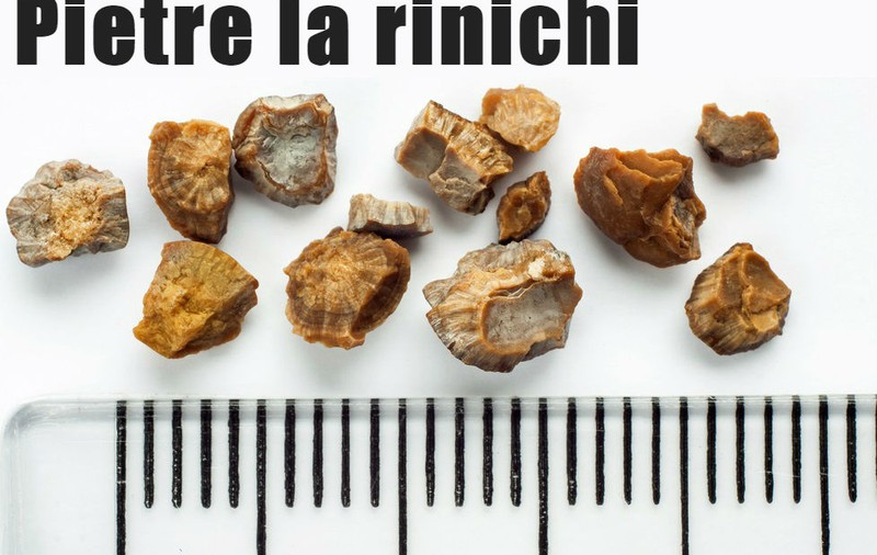 Greșeli care duc la apariția pietrelor la rinichi