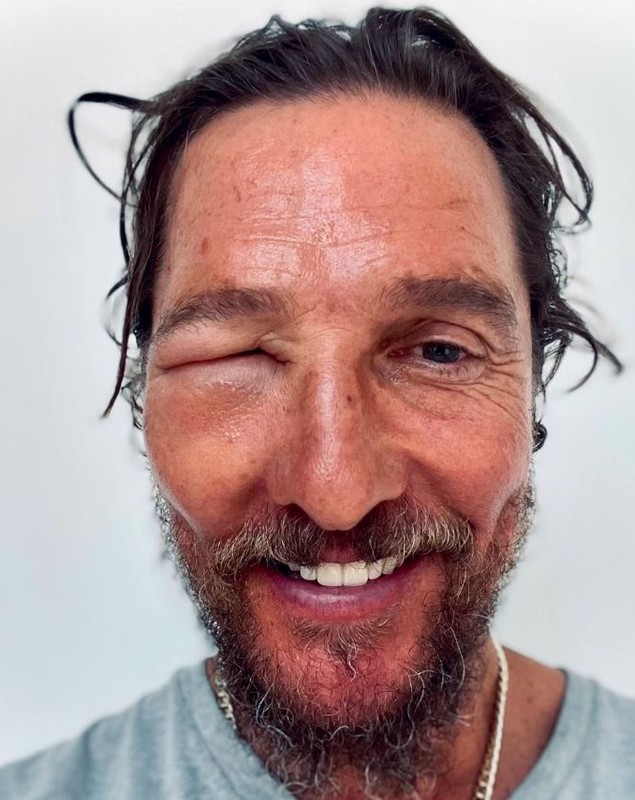 Matthew McConaughey și-a îngrijorat fanii după ce a apărut cu ochiul umflat. Ce a pățit actorul