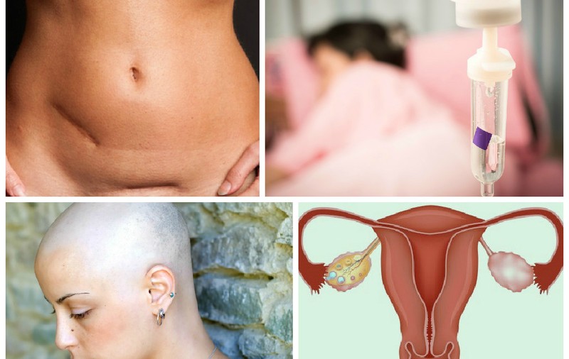 Cancerul ovarian – vezi care sunt simptomele!