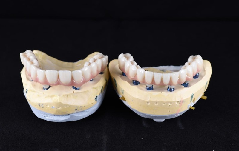 Ce înseamnă dantura fixă pe implanturi și cum te poate ajuta Ilieș Dental Clinic